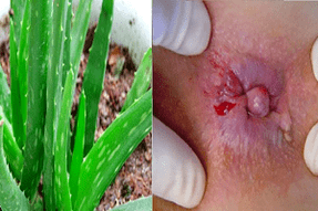 aloe aranyér kezelésére