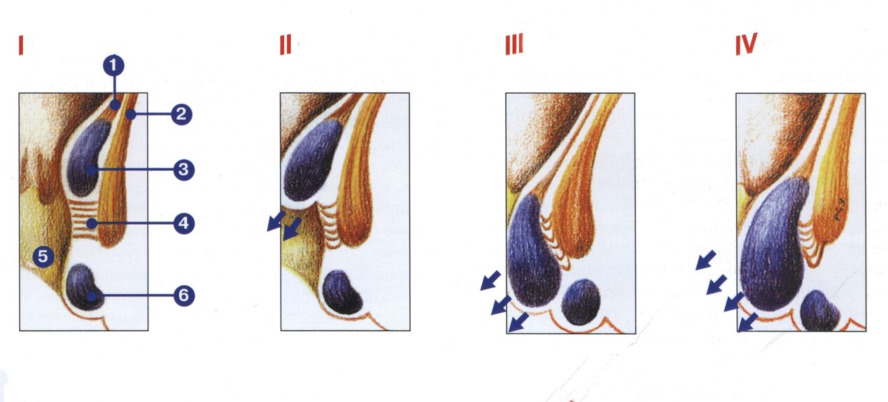 aranyér fejlődési szakaszai