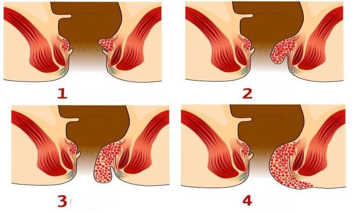 hogyan néz ki az aranyér a különböző szakaszokban